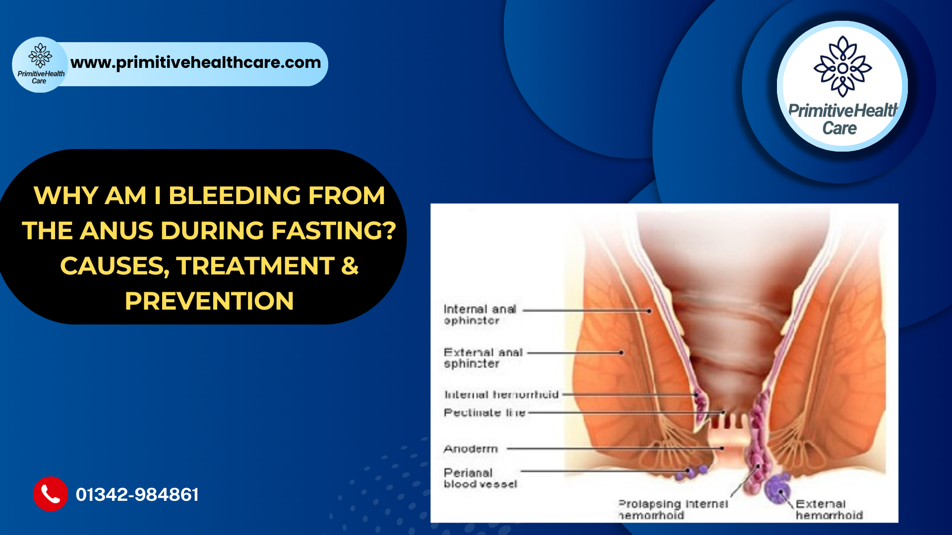 Why Am I Bleeding from the Anus During Fasting? Causes, Treatment & Prevention